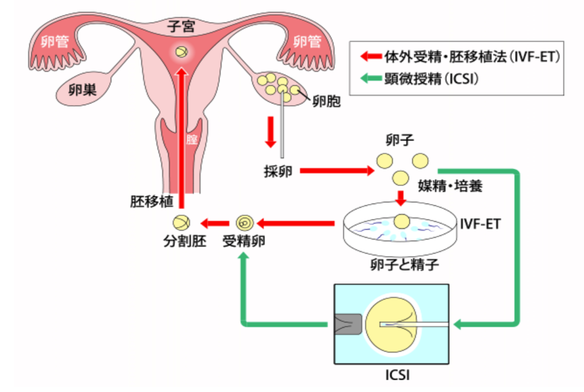 顕微授精 | アイリスウィメンズクリニック武蔵境【公式】東京都 不妊